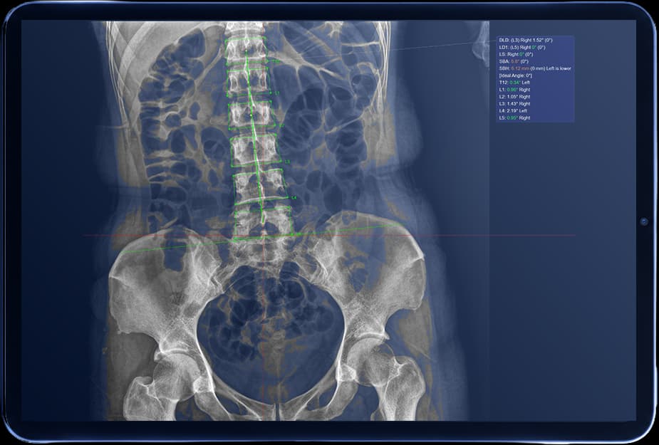 AP lumbar X-ray with vertebral landmarks and alignment measurements displayed on a tablet