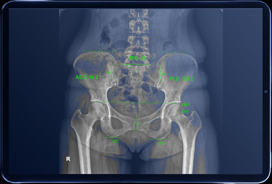 AP pelvis X-ray with green analysis annotations displayed on a tablet