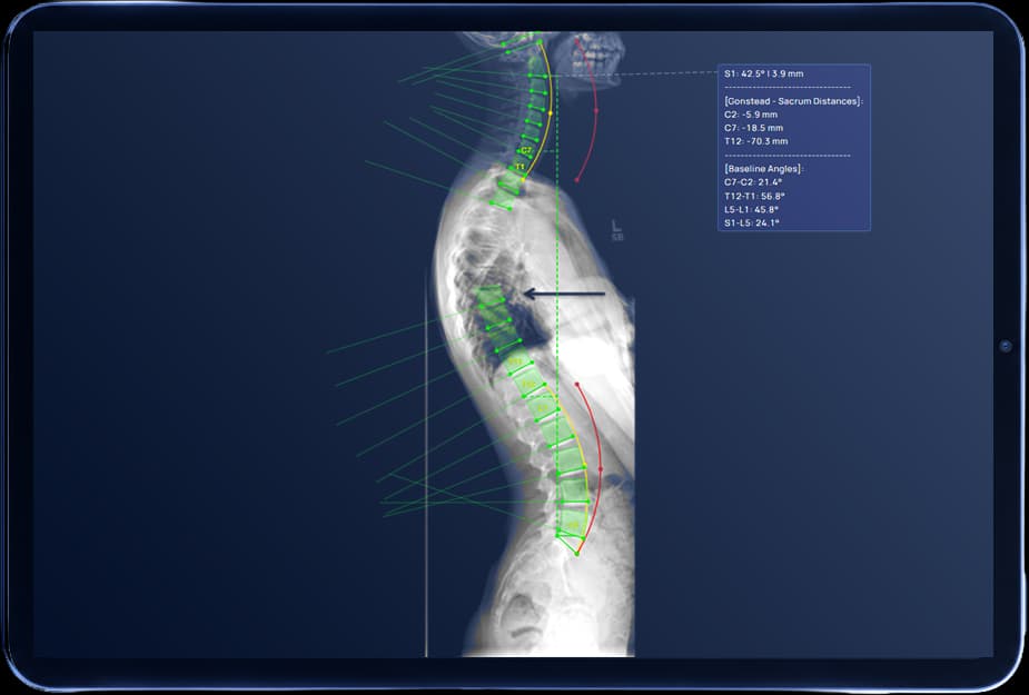 Full lateral spine X-ray with measurement annotations displayed on a tablet