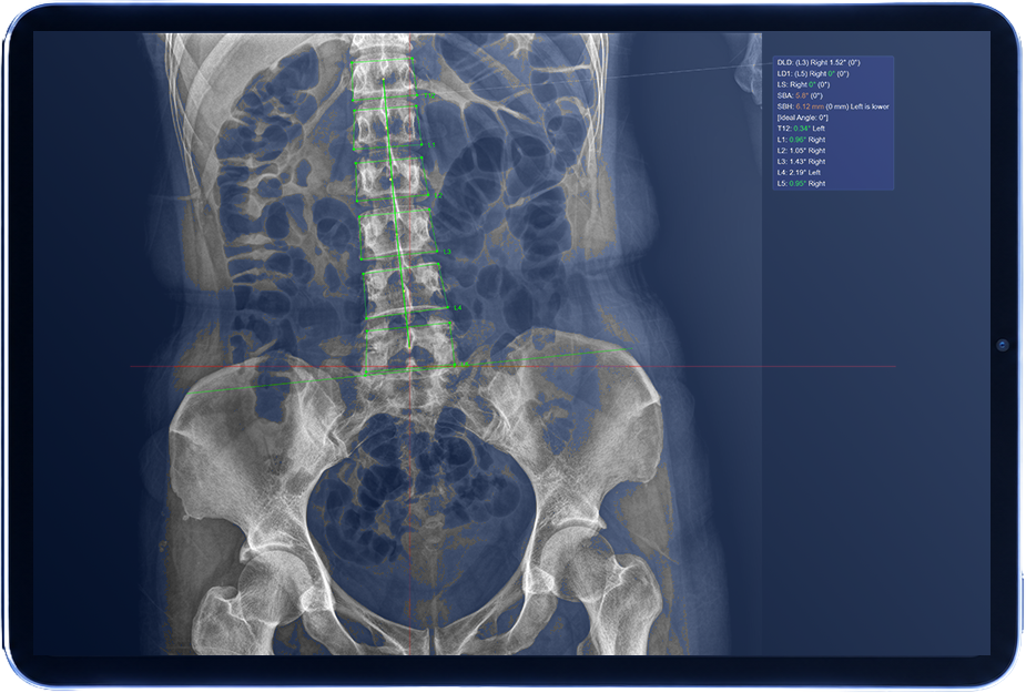 AP lumbar X-ray with vertebral landmarks and alignment measurements displayed on a tablet