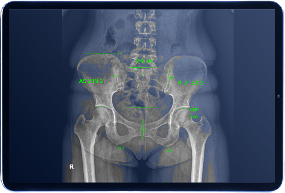 AP pelvis X-ray with green analysis annotations displayed on a tablet