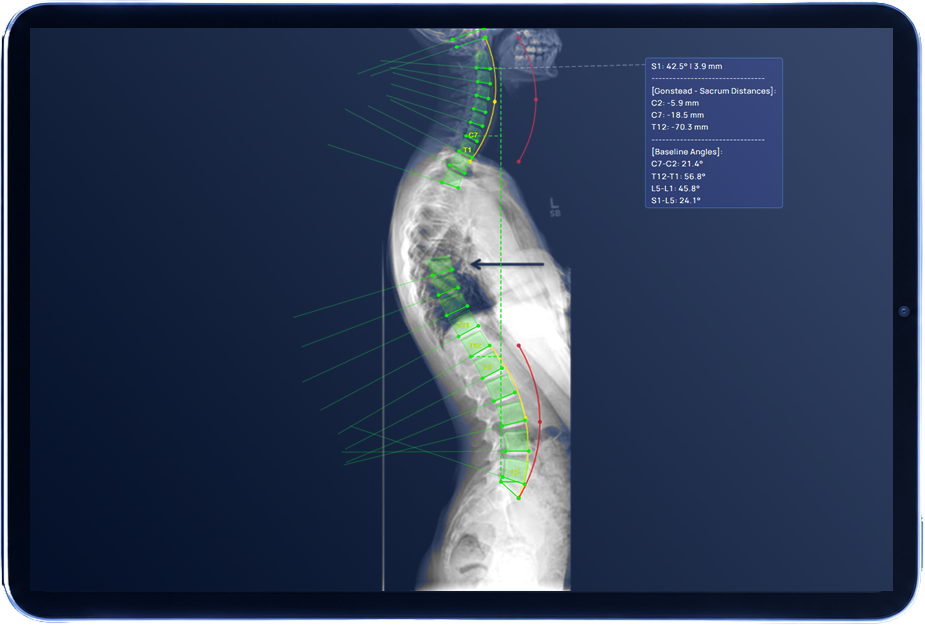 Full lateral spine X-ray with measurement annotations displayed on a tablet