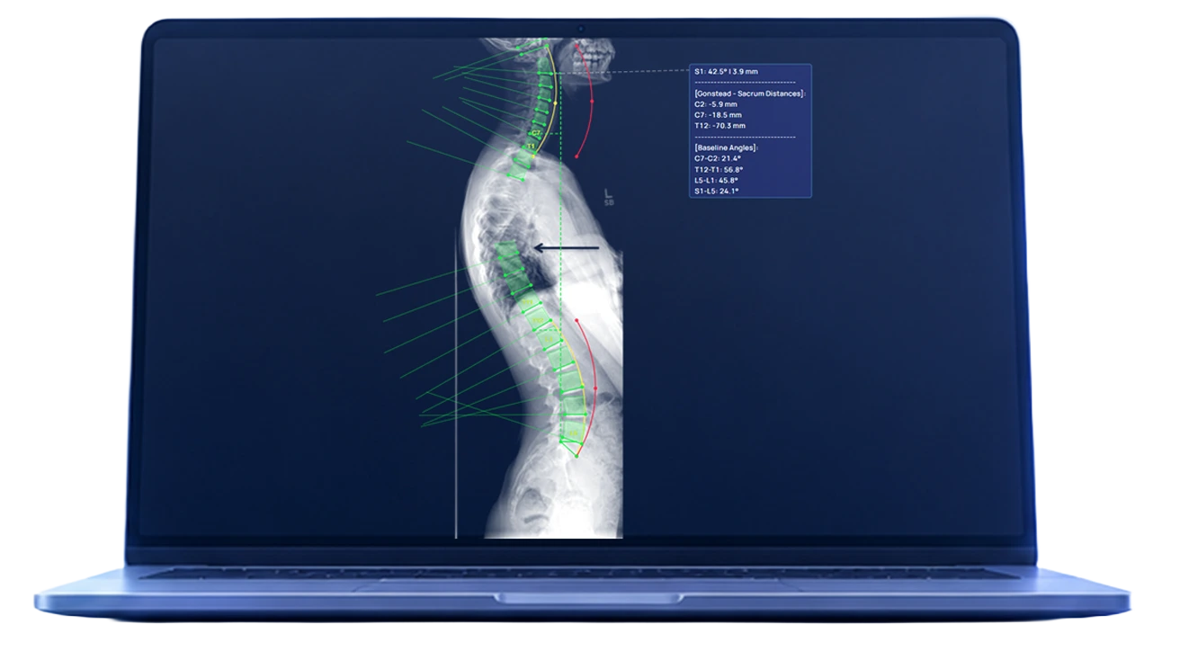 Full lateral spine product screenshot, zoomed to the cervical disc-space region